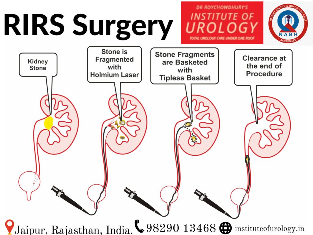 Best Hospital in Jaipur Rajasthan for RIRS Kidney stone laser surgery Dr. Rajan Bansal