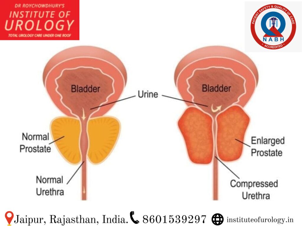enlarged prostate photo Dr. Rajan Bansal