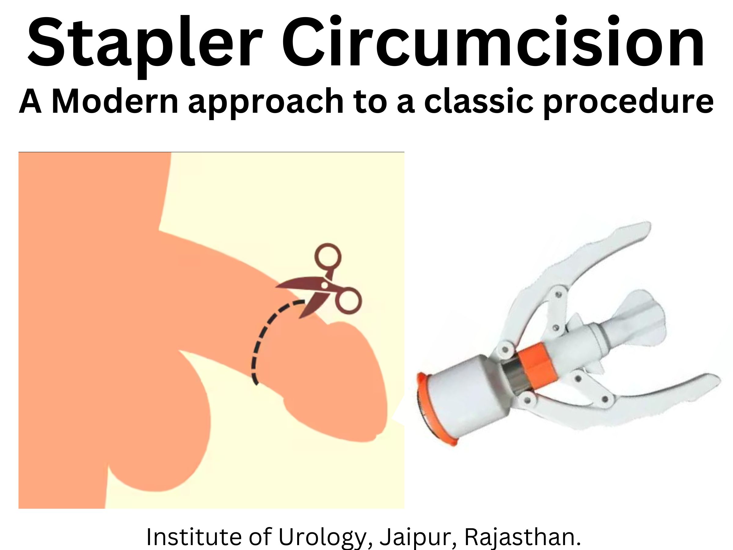 Stapler Circumcision Best Hospital in Jaipur Dr. Rajan Bansal Urologist