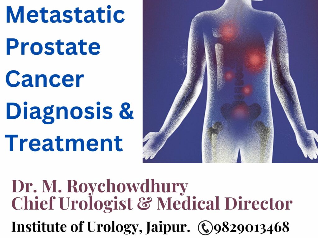 Metastatic Prostate Cancer Diagnosis & Treatment