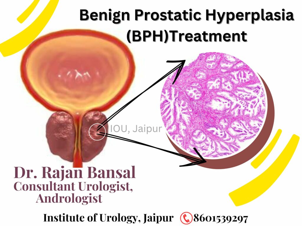 Benign Prostatic Hyperplasia (BPH) Treatment in Jaipur Dr Rajan Bansal MCH Urology Best Urologist in Jaipur Rajasthan