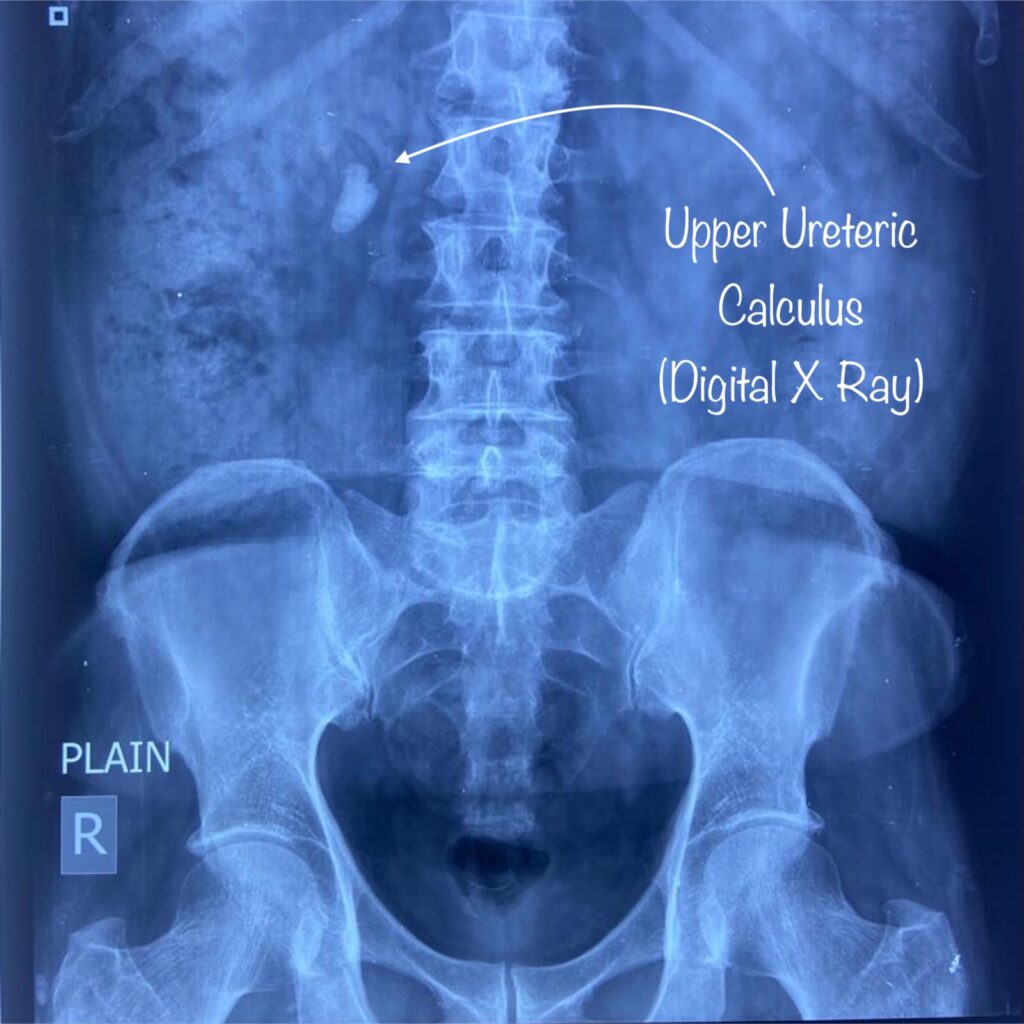 Stone in Upper Ureter Treatment by Dr. Rajan Bansal Best Urologist in Jaipur Rajasthan