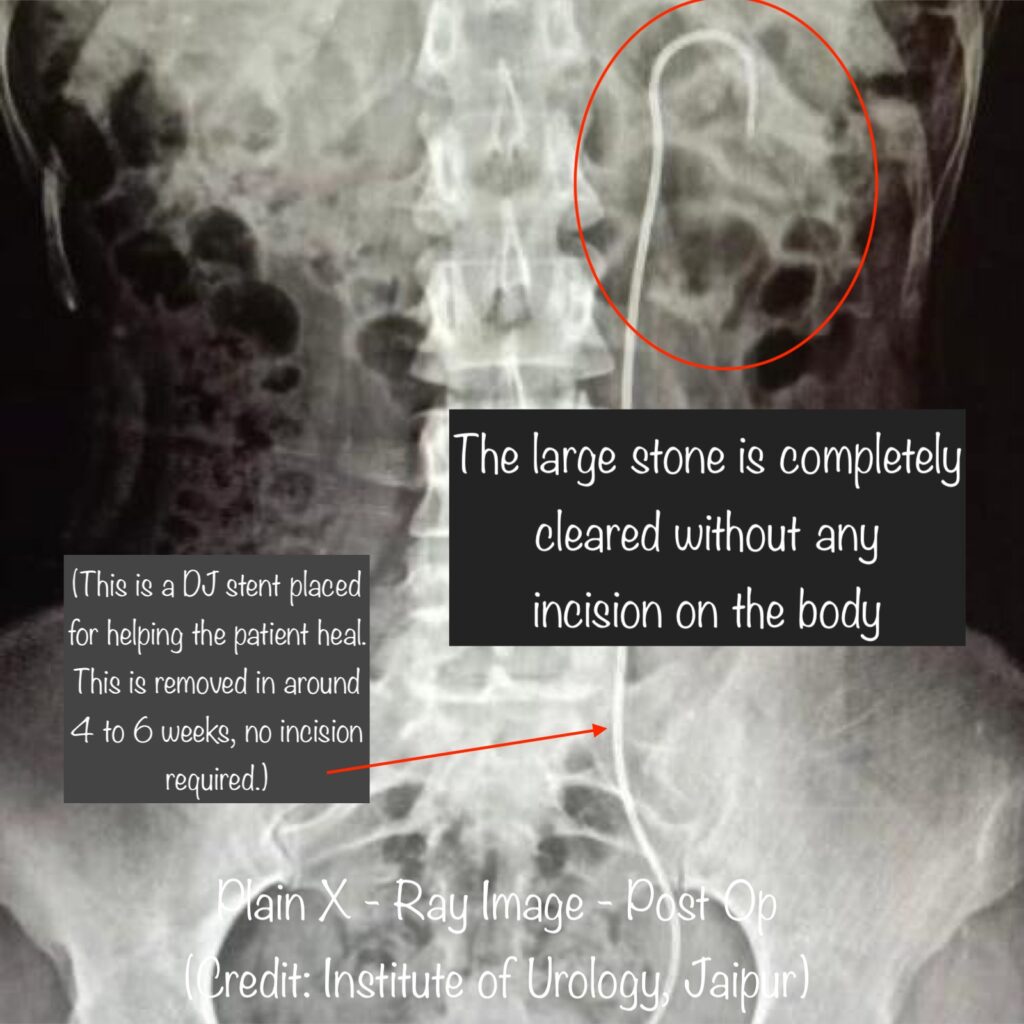 post op x ray Dr Rajan Bansal