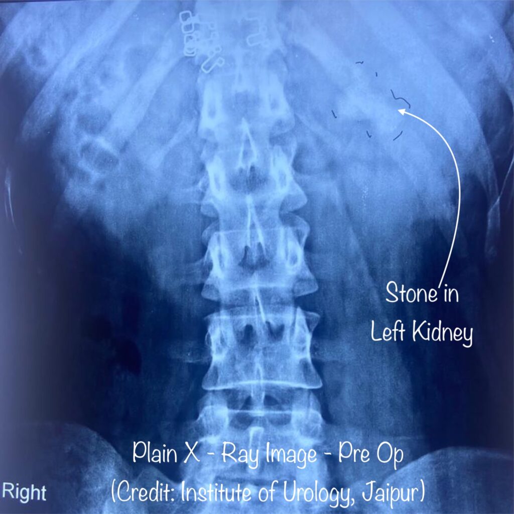 x ray kidney stone Dr Rajan Bansal