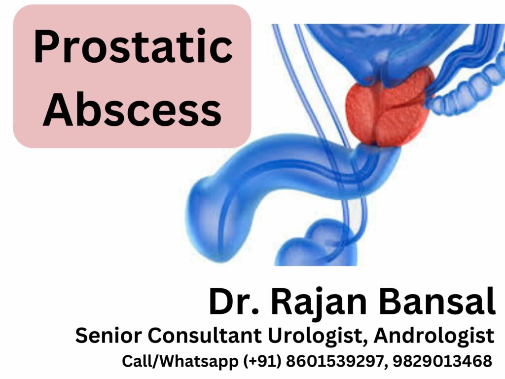 Prostatic Abscess Dr Rajan Bansal Best Urologist in India Rajasthan Jaipur