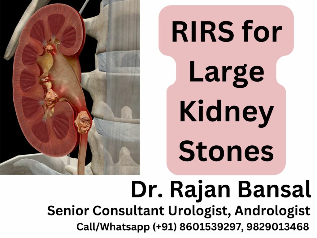 RIRS for Large Kidney Stone Treatment Laser Surgery In Jaipur Rajasthan India Dr Rajan Bansal