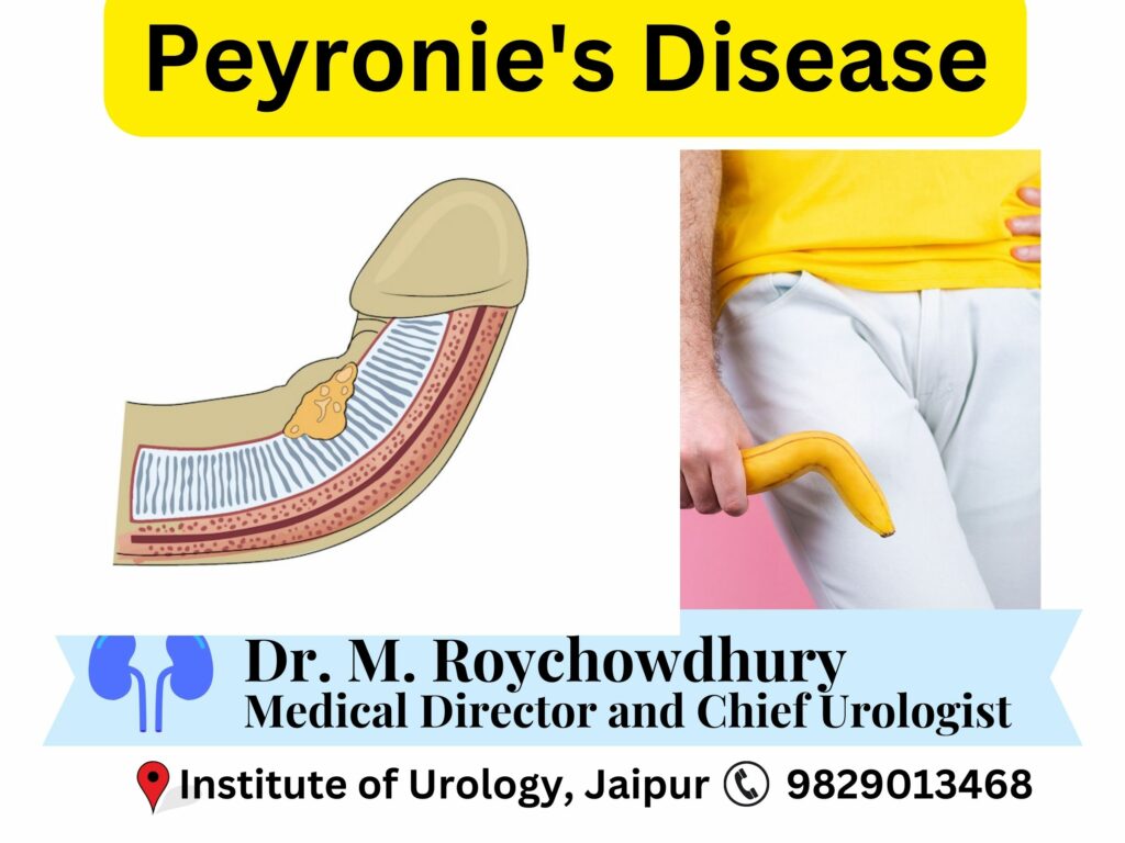Peyronie's Disease Treatment by Dr. Rajan Bansal Dr. M. Roychowdhury Institute of Urology, Jaipur Rajasthan