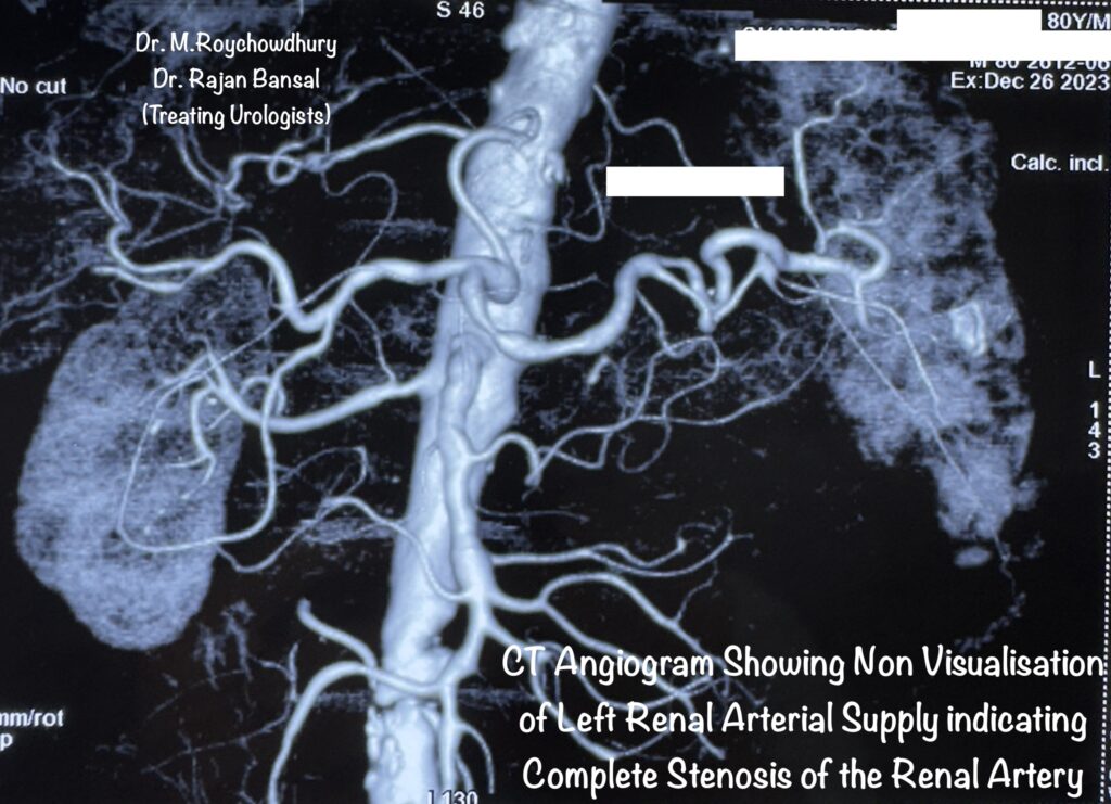Renal Artery Stenosis CT Angiogram Dr. Rajan Bansal