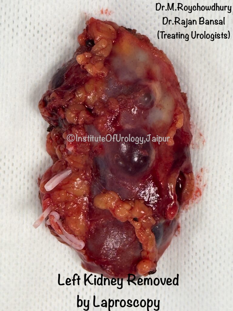 Renal Artery Stenosis Treatment by Dr Rajan Bansal Institute of Urology, Jaipur
