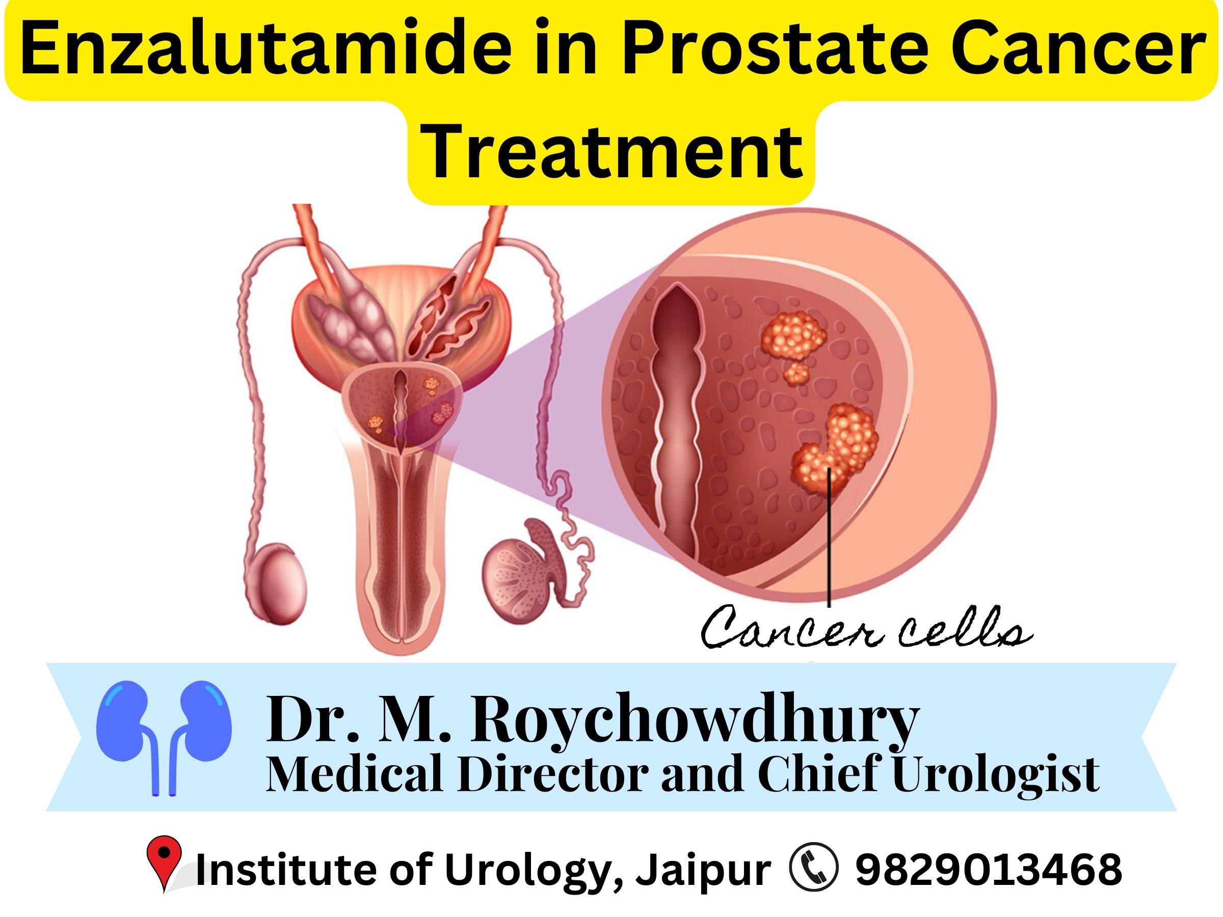 Enzalutamide in Prostate Cancer Treatment Institute of Urology, Jaipur Dr M Roychowdhury Dr Rajan Bansal