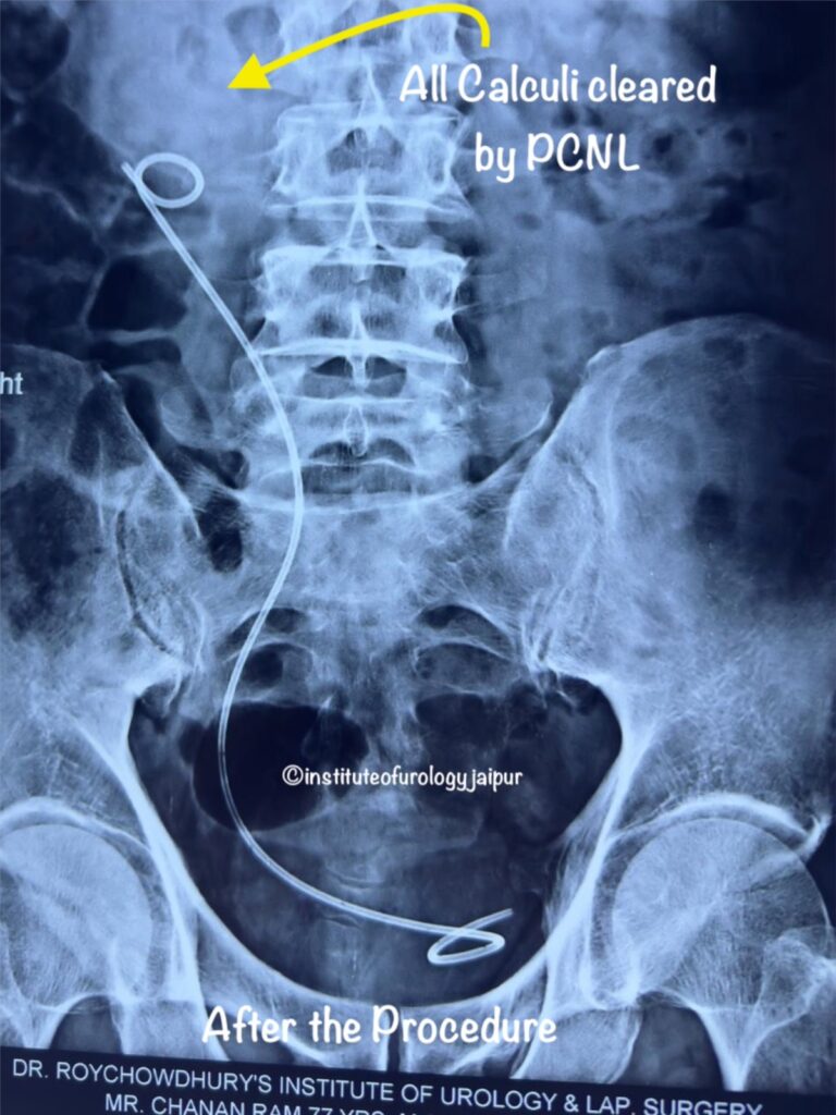 Kidney Stones PCNL X Ray Treatment by Dr. Rajan Bansal C Scheme Jaipur