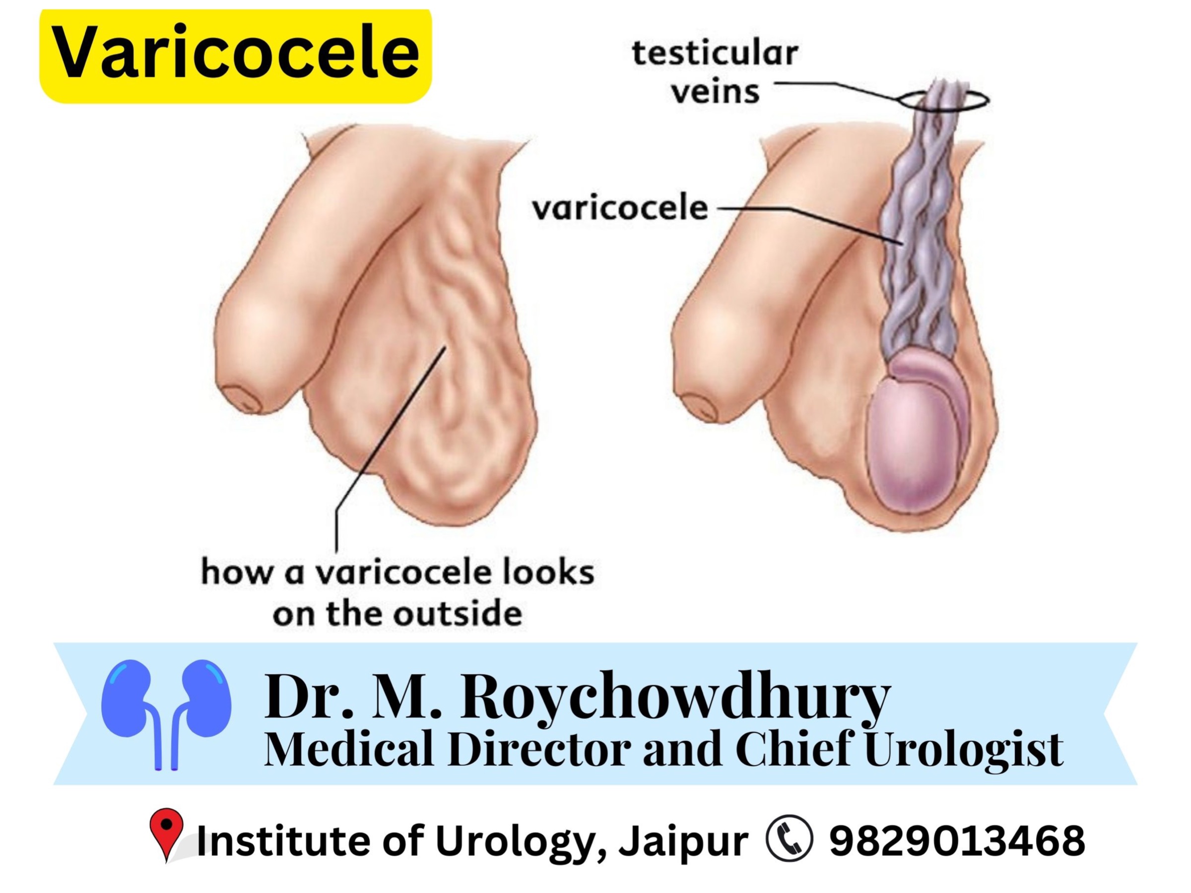 Varicocele Treatment in Jaipur Dr M Roychowdhury Dr Rajan Bansal Best Urologists in Rajasthan