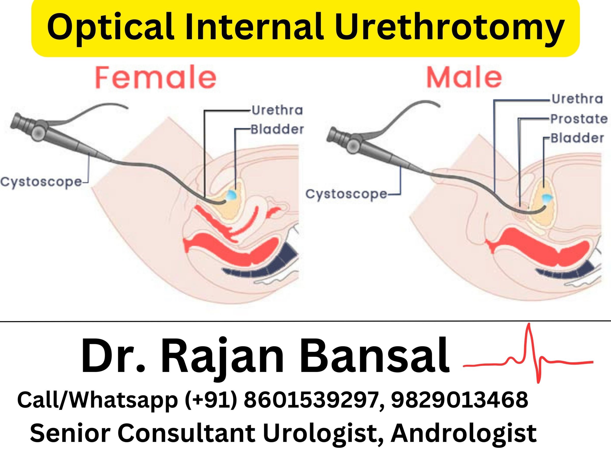 Drawbacks of Optical Internal Urethrotomy (OIU) Dr Rajan Bansal