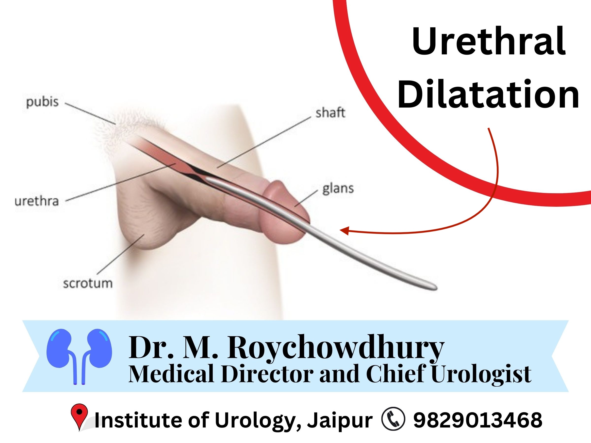 Urethral Dilatation A Non-Invasive OPD Procedure for Urological Strictures Dr M Roychowdhury Dr Rajan Bansal