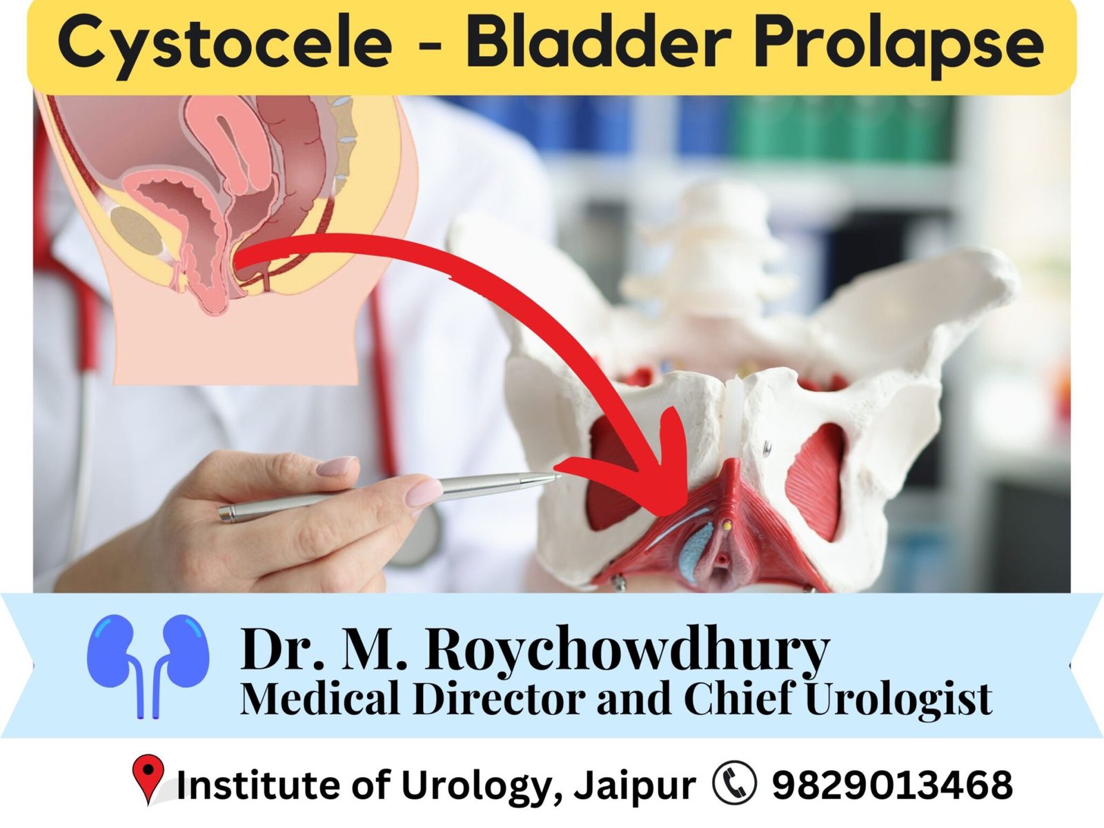 Cystocele Understanding And Managing Bladder Prolapse cystocele-understanding-and-managing-bladder-prolapse