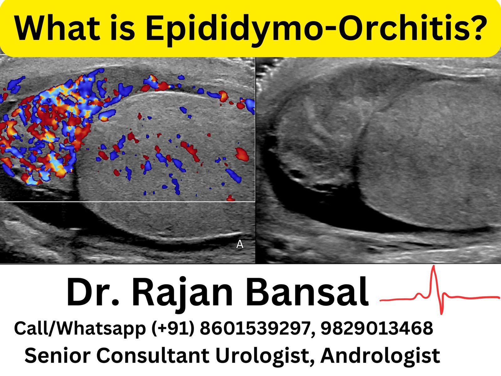 Epididymo Orchitis Causes