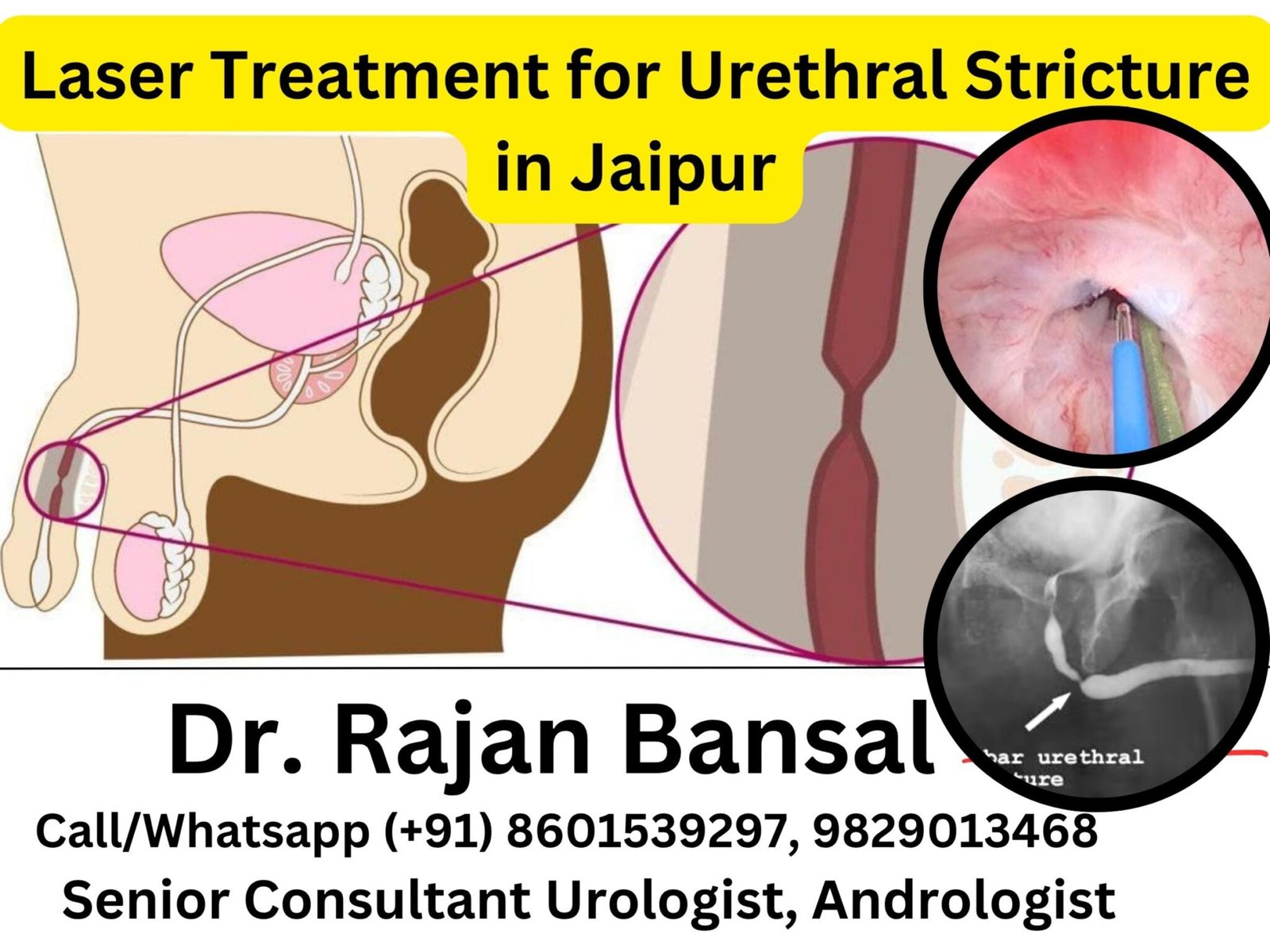 View of Urethral Stricture: Causes, Symptoms, Diagnosis, and Treatment