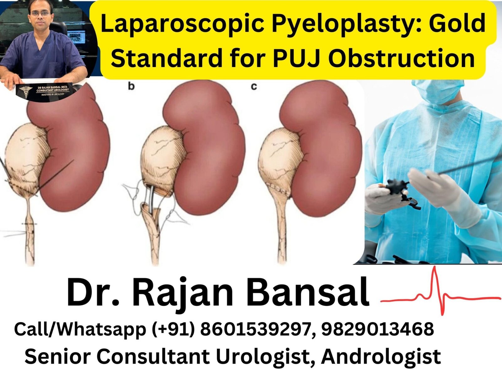 Puj Defination Pelvi-Ureteric Junction Obstruction (PUJO)
