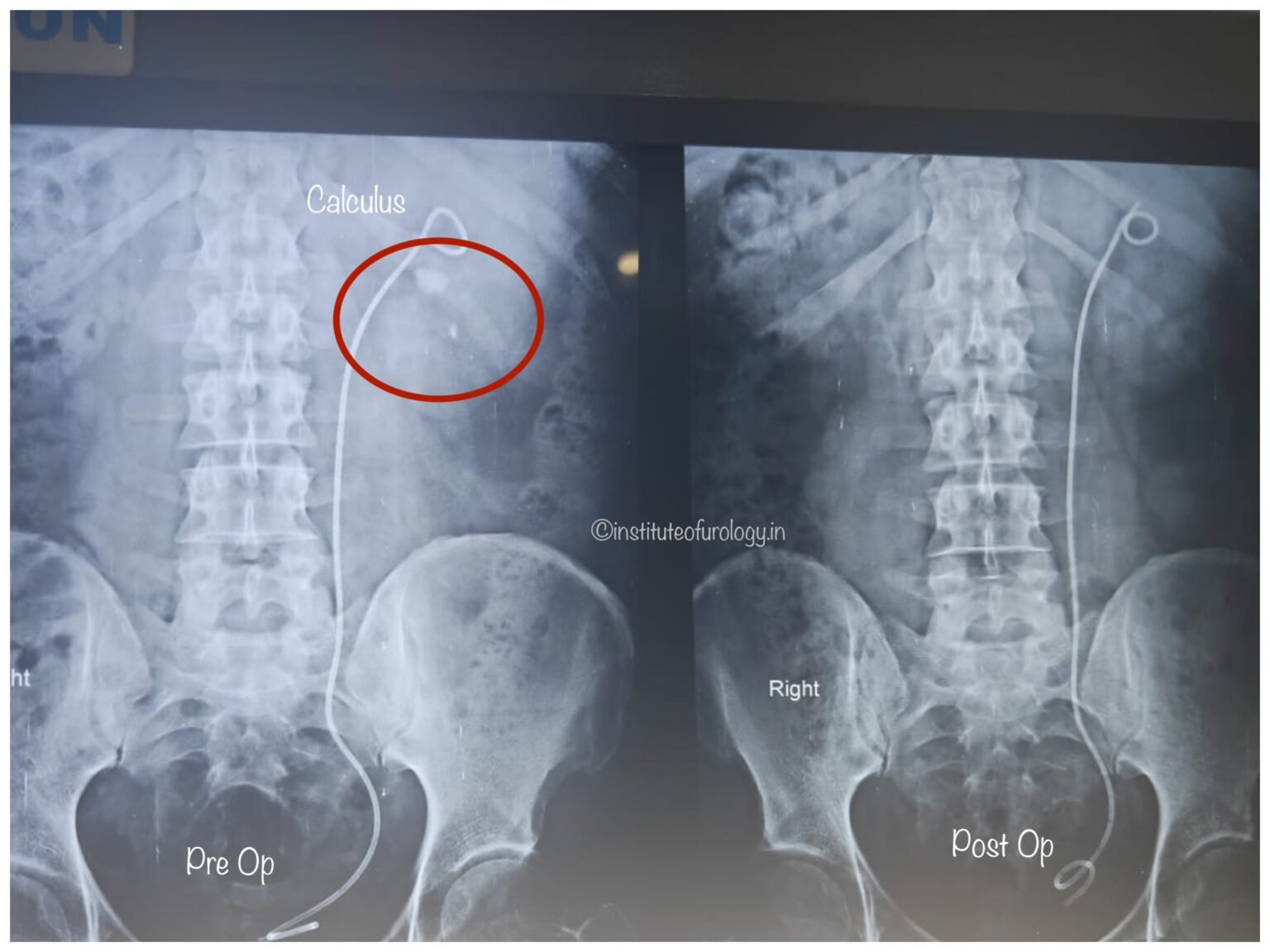 Calculus Lower Successful Management of Left Renal Pelvic and Lower Calyceal Calculi ...