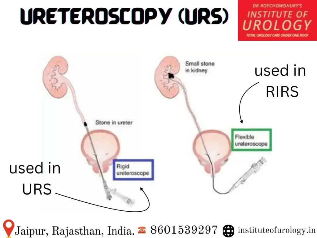 Ureteroscopy (URS) Procedure for Stones in Ureter Dr Rajan Bansal Urologist Jaipur