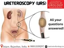 Ureteroscopy (URS) Procedure for Stones in Ureter Dr. Rajan Bansal