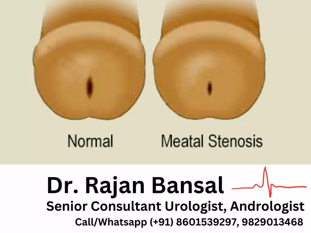 Meatal Stenosis Treatment Best India Dr. Rajan Bansal Urologist in Rajasthan Jaipur