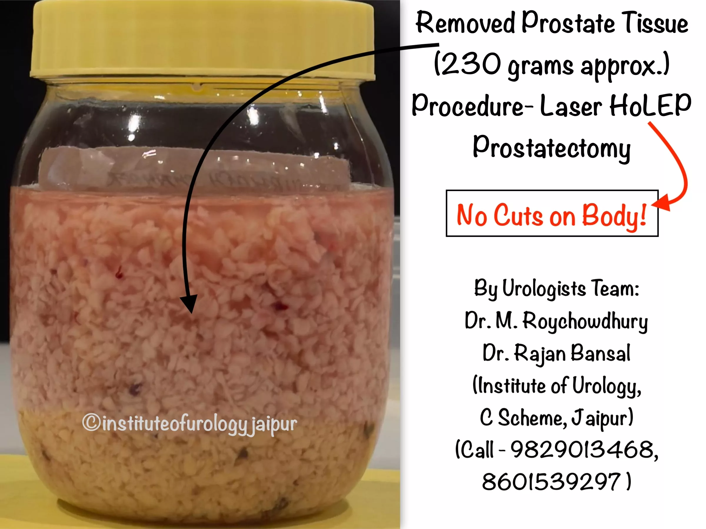 Large Prostate Surgery without any Cut on the Body at Institute of Urology, Jaipur Dr. Rajan Bansal