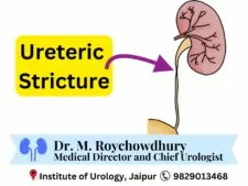 Ureteric Stricture Treatment by Dr. M. Roychowdhury Dr. Rajan Bansal in Jaipur