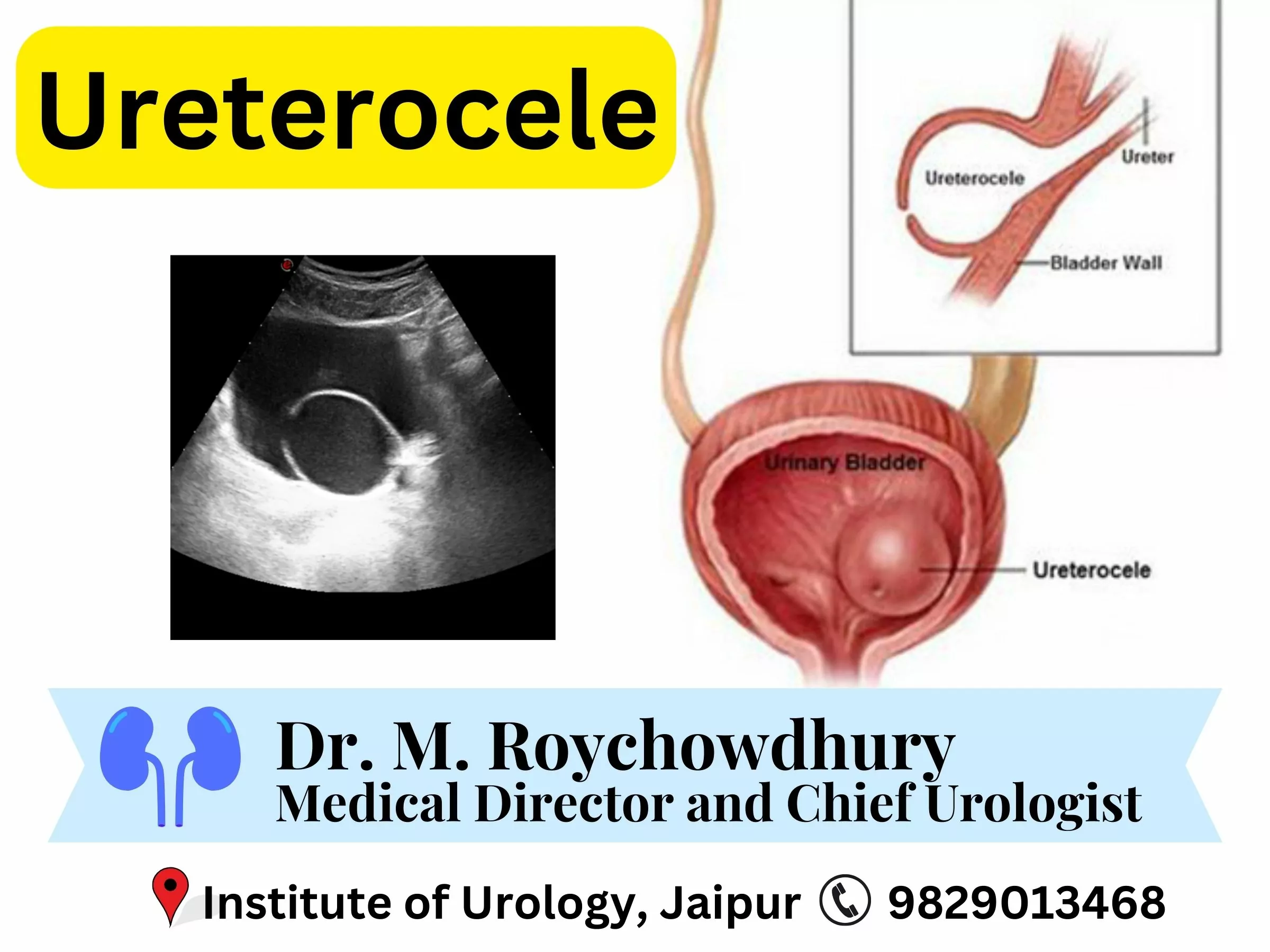 Ureterocele Treatment by Dr. Rajan Bansal Jaipur Rajasthan