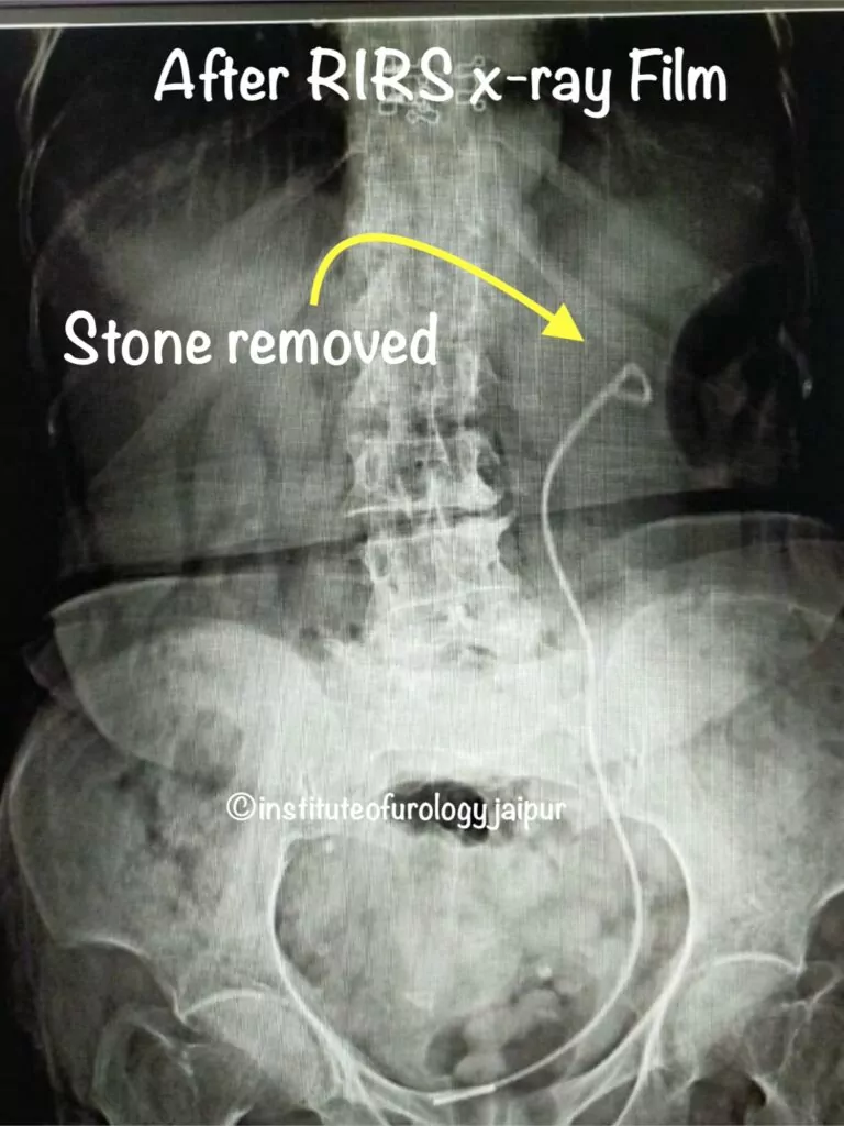 Best hospital for kidney stone treatment RIRS before after x ray