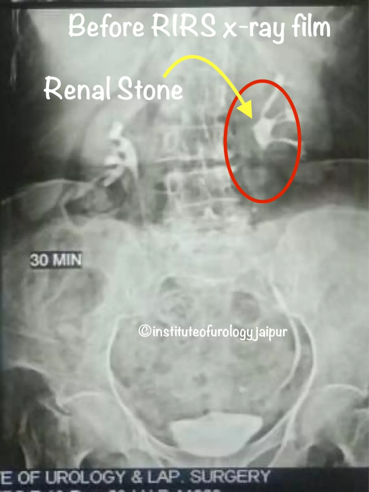 Best hospital for kidney stone treatment RIRS