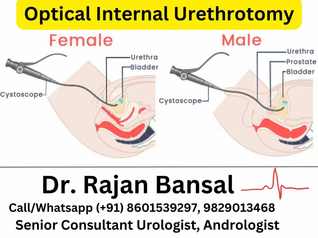 Drawbacks of Optical Internal Urethrotomy (OIU) Dr Rajan Bansal