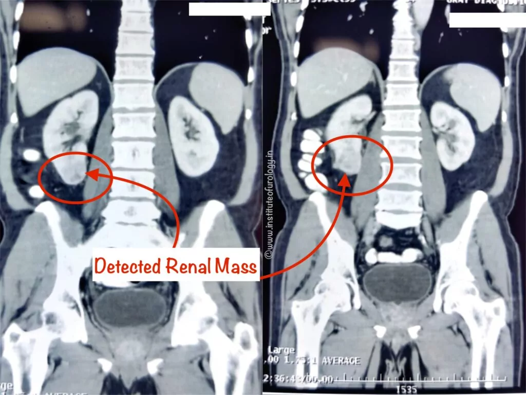 Small Rcc Usg Partial Nephrectomy for Small Renal Tumour at Institute of Urology, Jaipur