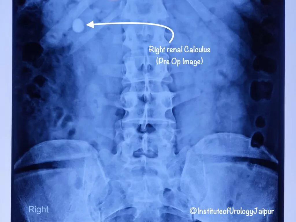 Best Hospital for Scarless Kidney Stone Treatment (RIRS) in Jaipur